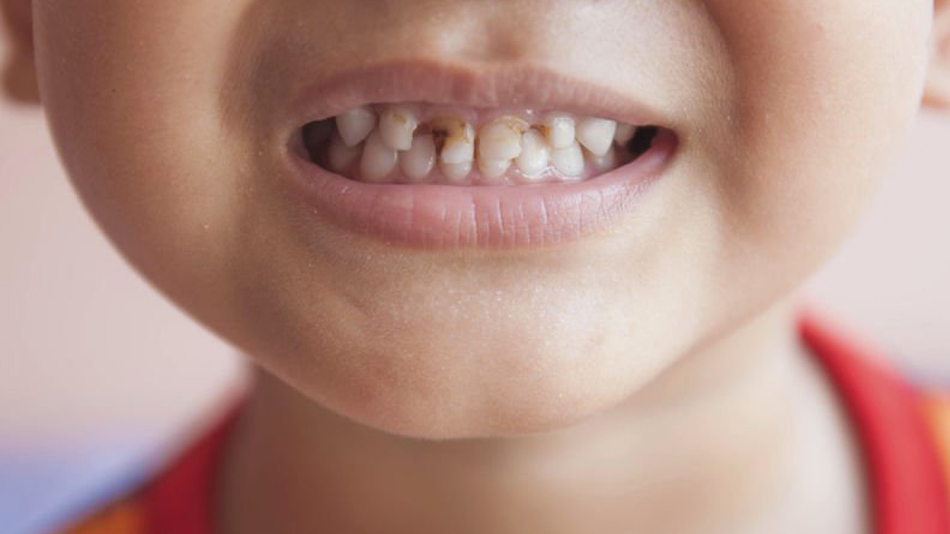 Les dents des enfants ravagées par le sucre - Manger Citoyen